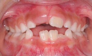6歳、叢生、八重歯・乱ぐい歯、出っ歯、開咬