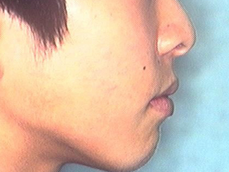 治療後 横顔