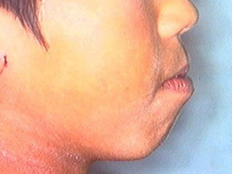 初診時 横顔