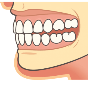 矯正治療とくいしばり（ブラキシズム）について