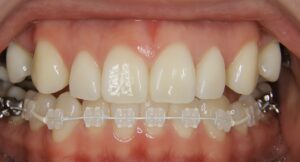 目立ちにくい矯正装置 – ハーフリンガルの矯正治療【茨城県石岡市の矯正専門クリニック・石岡みらい矯正歯科】