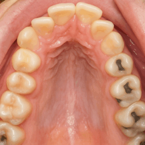 口呼吸と歯並びについて