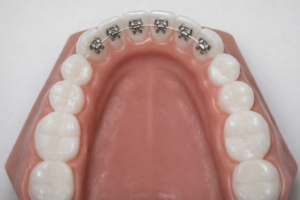 部分矯正治療について- 全顎矯正治療の利点【茨城県石岡市の矯正歯科クリニック・石岡みらい矯正歯科】