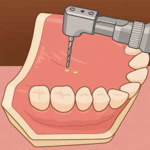 矯正用アンカースクリュー植立の流れ（インプラントアンカー）【茨城県石岡市の矯正歯科医院・石岡みらい矯正歯科】