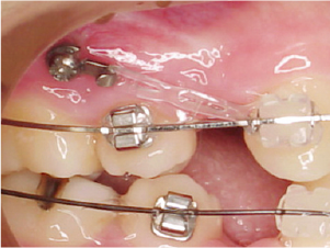 インプラントアンカーについて（概要）