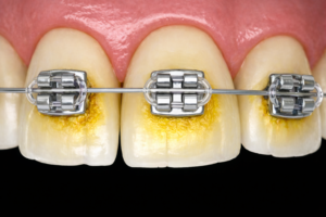 歯の着色（ステイン）への対策について【茨城県石岡市の矯正歯科医院・石岡みらい矯正歯科】