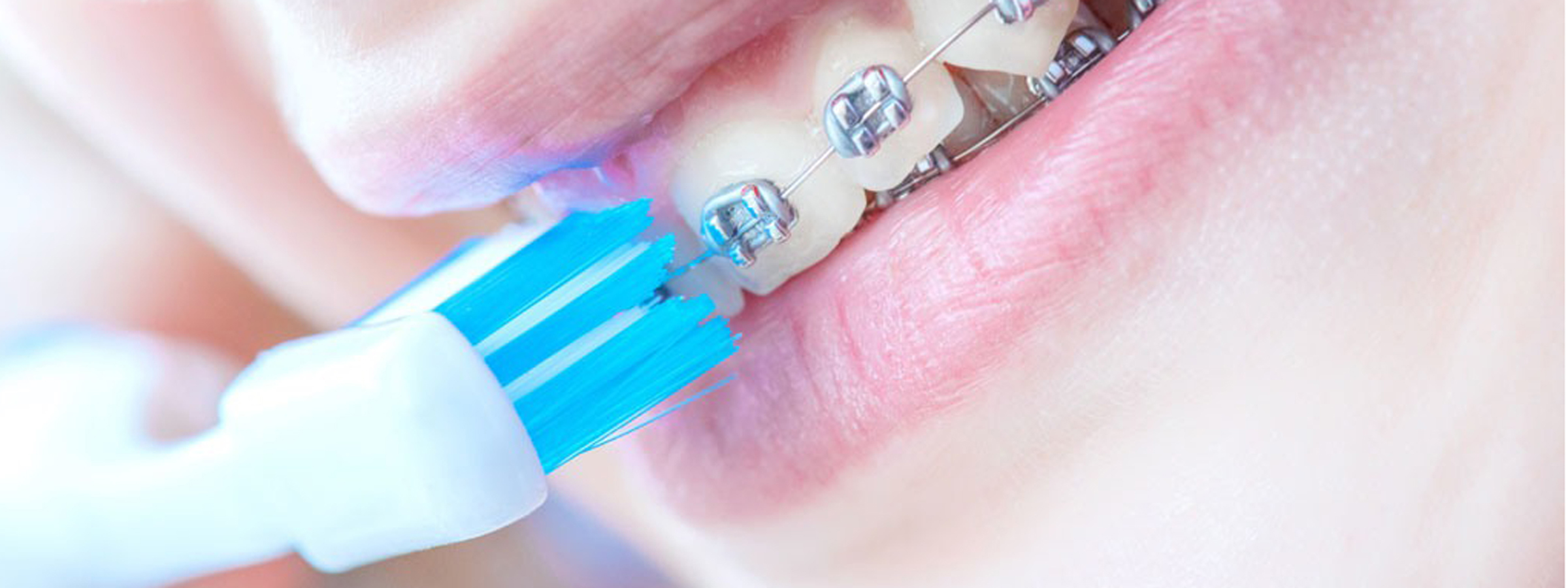 矯正治療中の虫歯予防
